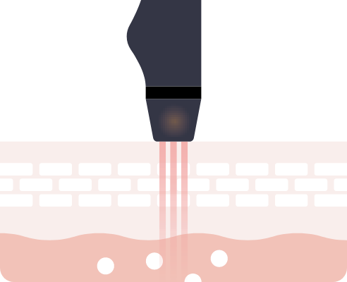 サーマルフラクショナル