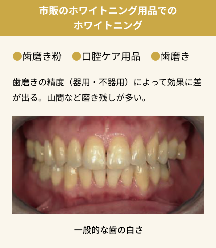 市販のホワイトニング用品でのホワイトニング
